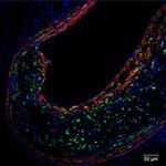UVA Determines ‘Fountain of Youth’ Gene Helps Prevent Heart Attack, Stroke