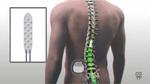 Man moves paralyzed legs using device that stimulates spinal cord