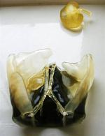 Surgeons Use 3D Printing for Two-Year-Old’s Life-Saving Kidney Transplant at Guy’s and St Thomas’ NHS Foundation Trust