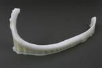 3D printed rib implanted in the human body