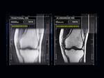 How AI Is Accelerating MRI Scans